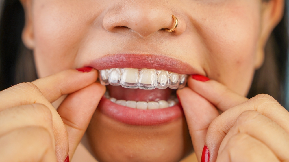 In-Office Invisalign Financing featured image