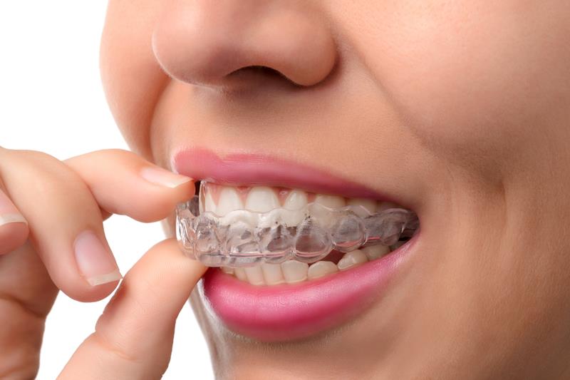 Invisalign featured image